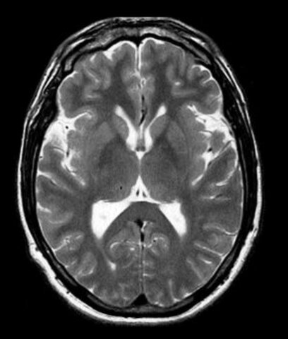 Logrado por Félix Bloch y  Edward Purcell