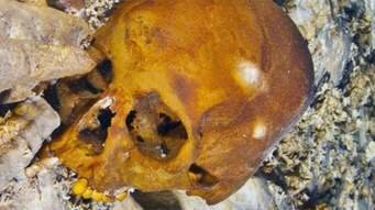 "Traumatismos Esqueléticos no Reconocidos"