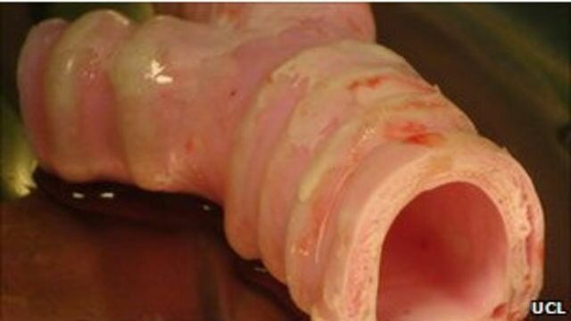 Realizan el primer trasplante de órgano sintético del mundo