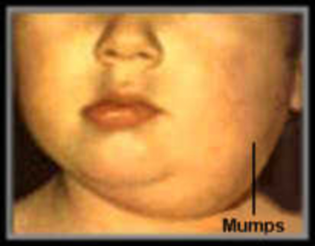 Invention of the Mumps Vaccine by Maurice Hilleman