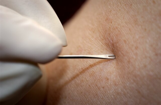 Bifurcated Needle