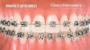 braces