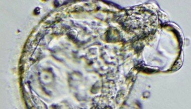 diagnoser til menneskefoster