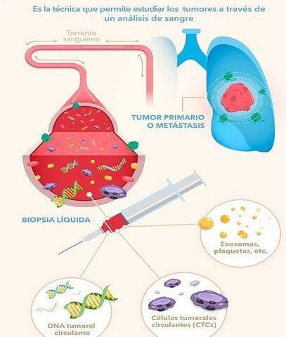 Biopsia líquida para el ADN tumoral circulante