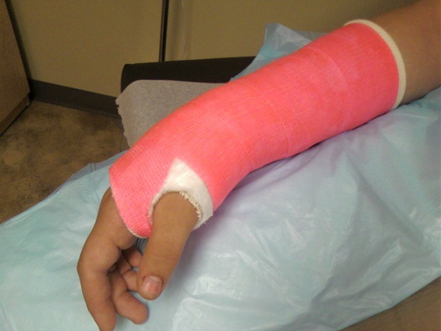I broke my arm