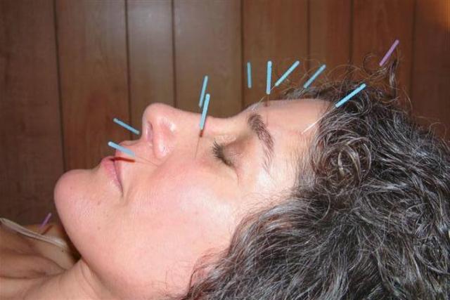 The chinese used acupuncture to relieve pain and congestion