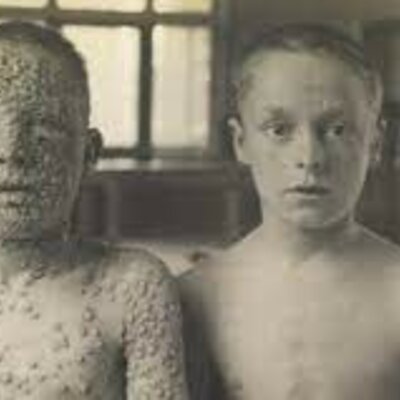 Timeline: Smallpox
