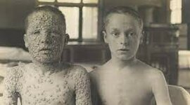 Timeline: Smallpox