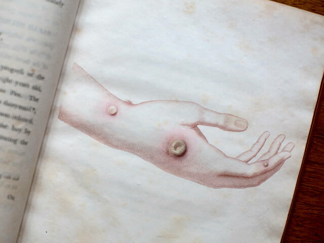 Artifact 1: Cowpox Lesion