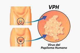Papiloma Humano