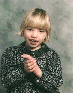 Síndrome del maullido de gato