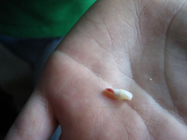 When I Lost my First Tooth