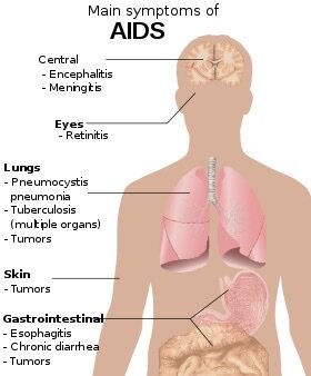 AIDS