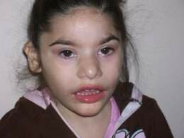 Síndrome de Angelman