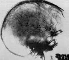 Primera angiografía.