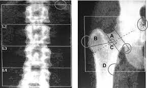 Descubrimiento de la densitometría ósea
