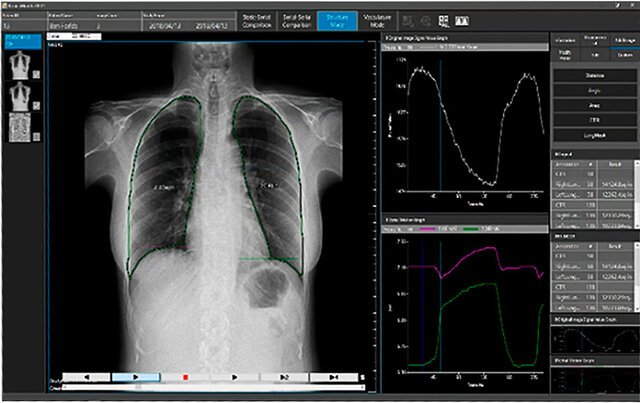 Primer Sistema de Radiología Digital Directa