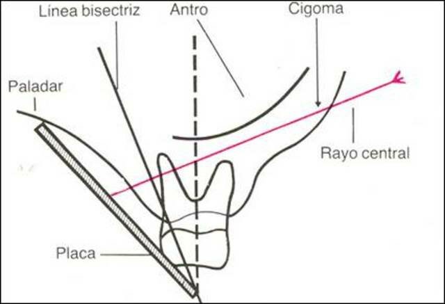 Técnica de la bisectriz