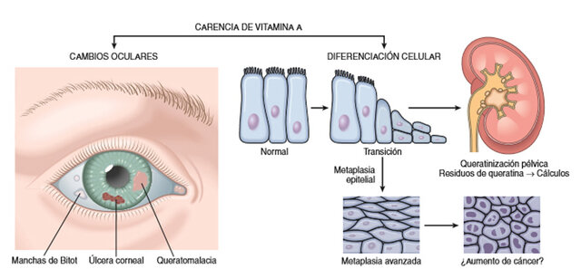Deficiencia de vitamina A
