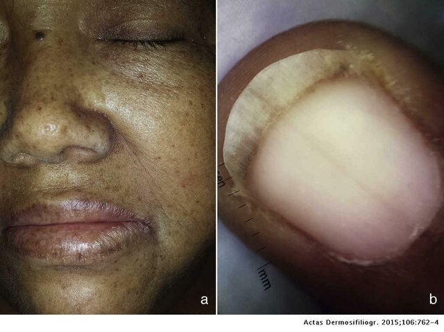 Deficiencia de vitamina B12