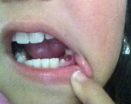 Ma première dent de bébé est tombée