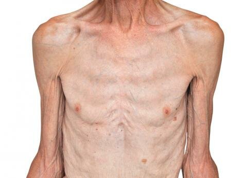 Deficiencia de Hierro