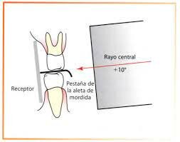 Técnica de aleta mordible