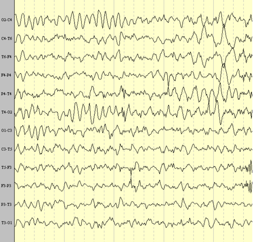 Primer electroencefalograma humano.