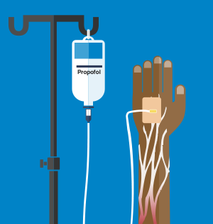 Propofol Annesthesia