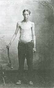 The Scourge of the South—Hookworm