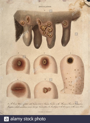 La viruela y las ordeñadoras