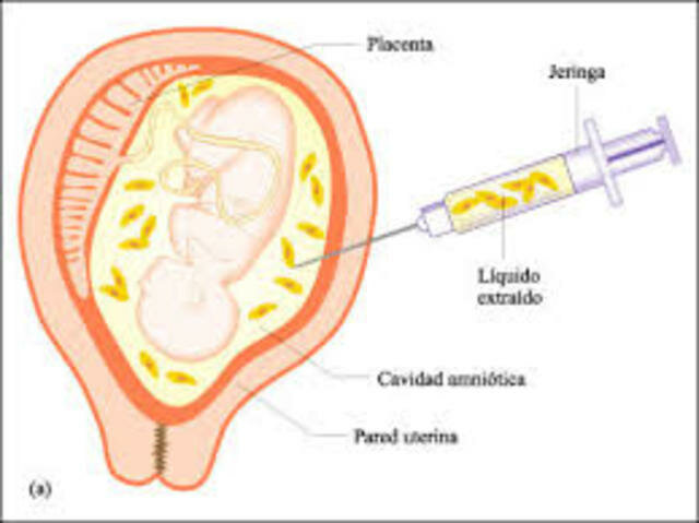 Primer diagnóstico prenatal de una enfermedad humana por medio del análisis del ADN