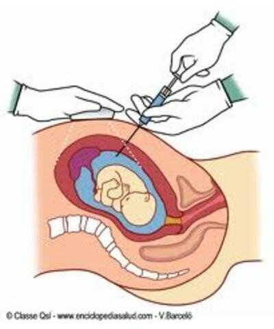 1981. Primer diagnóstico prenatal analizando el genoma del feto en la sangre de la madre