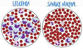 Primer reporte del uso de la terapia genética contra la leucemia.