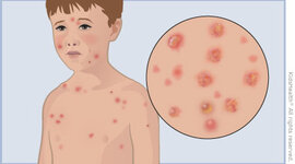 Timeline: Evolución de la Varicela