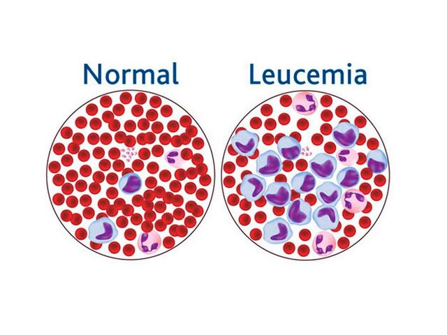 Terapia genetica contra la leucemia