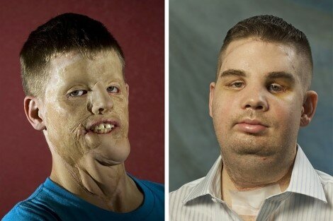 Trasplante De Rostro Completo