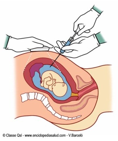 Primer diagnóstico prenatal por ADN