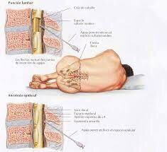 Preparación y regulación tejidos a nivel intratecal