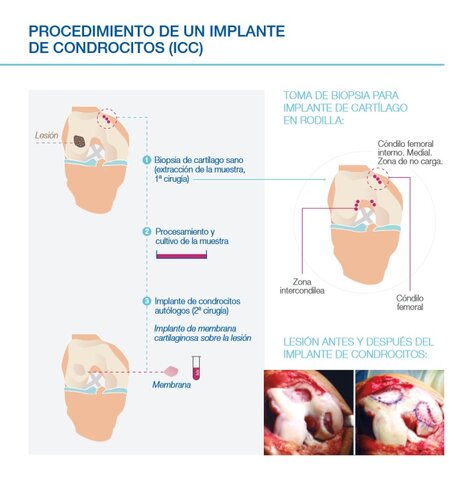 Implantes celulares