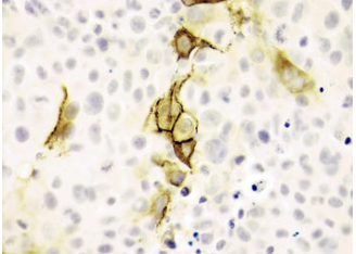 Nueva terapia génica para tratar diferentes tipos de cáncer con yodo radiactivo