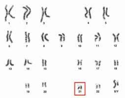 El síndrome de Down