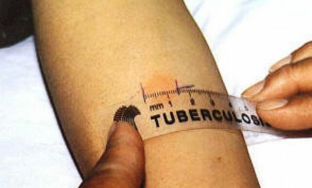 Vaccino per la tubercolosi