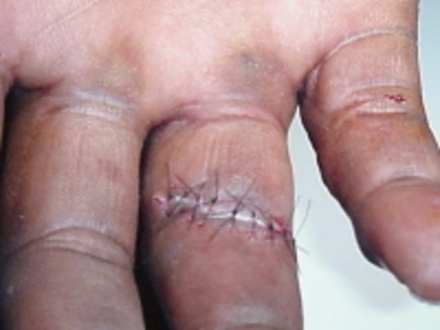 first time i got stiches