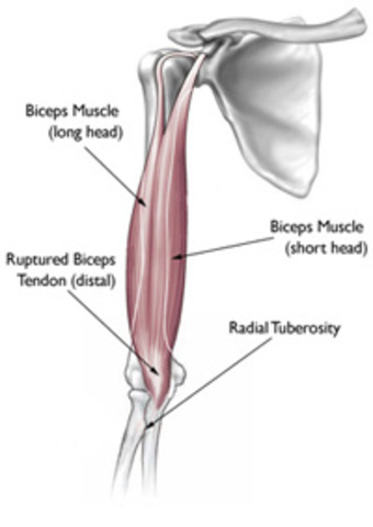 Tore a ligament in my arm .