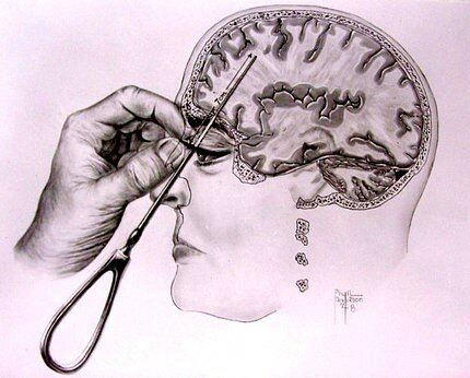 The development of the Lobotomy procedure