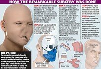 The first full face transplant