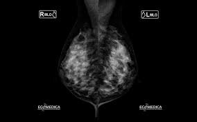 La mamografia digital