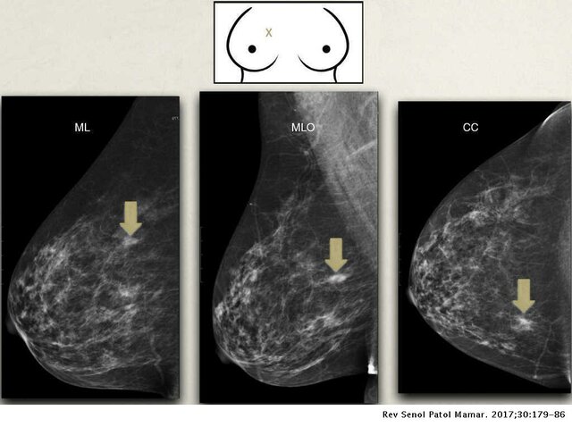 Foto Mamográfica (2000)