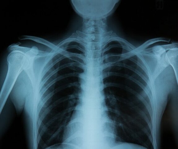 X rays